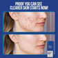 Wiki Special Acne Serum
